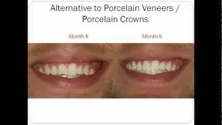 Dark Tooth Smile Fixed = Invisalign + Manhattan Method for Teeth Whitening...Dental Tutorial