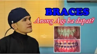 BRACES: Does Age Matter? (Anong edad ba dapat magbraces)