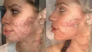 Melissa Roocroft in the Acne Category for The Skin Games 2020 | Video 6