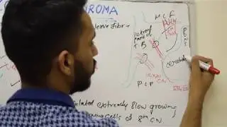 ACOUSTIC NEUROMA