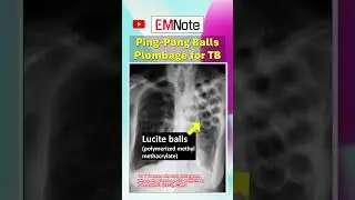 Ping Pong Balls Plombage for TB #doctor #medical