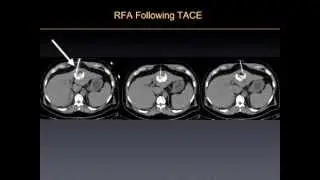 UCSF Radiology: Killing Cancer Tumors w/ Radiofrequency Ablation Therapy