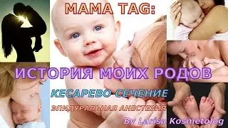 MAMA TAG: История моих родов. Опыт кесарева сечения и перидуральной анестезии
