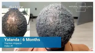 How Exosome Therapy Supports Hair Transplant Results | Dr. Blumenthal (Yolanda)
