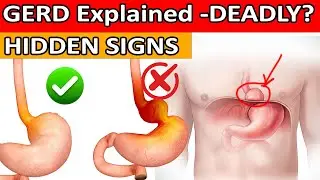 10 Hidden Acid Reflux (GERD) Symptoms You Should Never Ignore!