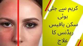 Face Redness/Jaali hoi Skin/cream reaction/How to remove face redness naturally