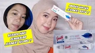 OBAT JERAWAT BATU ? | Review Verile Acne Gel || Gisti Prilastri