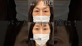 クマ治療で自信を持てるように#クマ治療 #目の下のクマ #クマ取り #美容 #若返り #整形 #イソセン#ybc横浜美容外科