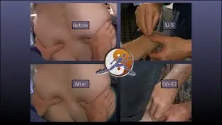 Improving Pelvic Motion with Sports Medicine Acupuncture&reg; - Normalizing a Positive Gillet&rsquo;s Test