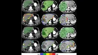Automatic Liver and Tumor Segmentation from CT-scan Images using U-Net & ResNet |Deep Learning|