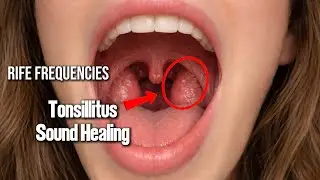 Tonsillitis - Sound Healing With Rife Frequencies (Part 2)