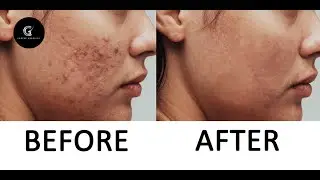how to remove pimples in your picture in 1min