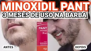 MINOXIDIL PANT - 3 MESES DE USO COM FOTOS DE ANTES E DEPOIS NA BARBA - ACHÉ - 2024