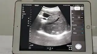 The Cheapest Color Doppler Ultrasound-P5C