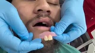 Flexible denture At Ardmore Dental