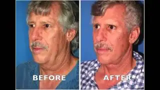 Rhinoplasty in Portland Oregon - Nose Surgery