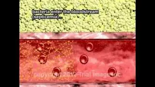 Band Cells, Nucleated Red Blood Cells,  and Septicemia video - Animation by Cal Shipley, M.D.