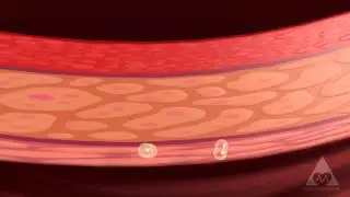 Hypertension Treatment with EECP&reg; - Global Cardio Care