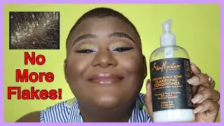 Get rid of that crusty scalp, girl!! :: Seborrheic Dermatitis, Dandruff, and Dry Scalp on 4C Hair