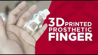 Finger Prosthetic Project by 3D2GO