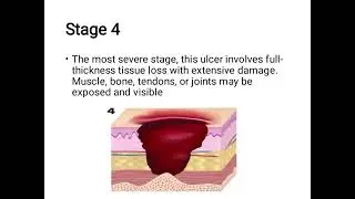 Decubatic Ulcer/ pressure ulcer/ bedsore