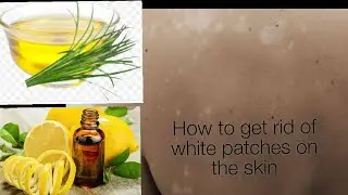 How to get rid of white patches on the skin #skincare #whitepatches