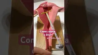Como colocar o DIU?