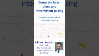 Complete heart block and intermittent pacing