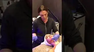 DERMALINFUSION Skin Resurfacing Facial Treatment | Live