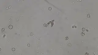 Septate fungal hyphae in KOH mount of Urine