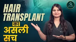 When Do You Get the Best Hair Transplant Results? 😊 | Hindi