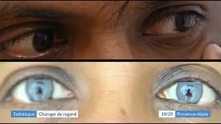 BIOTIC Phocea corrige les défauts de la cornée par la Keratopigmentation sur FR 3