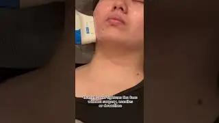 No-downtime Face Lift Procedure with Ultraformer MPT