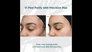 Best Chemical Peels in Dallas: VI Peel Precision Plus & Purify for Face at Sanjiva Medical Spa