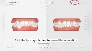 ICX-P5 Quick Start Tutorial &ndash; Intraoralscanner f&uuml;r digitale Zahnmedizin