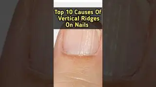 Do you Have vertical ridges on nails??? #shorts #youtubeshorts #top10