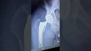 Hip Replacement Skateboard Recovery Journey. Day 28. #hipreplacement #skateboardvibes