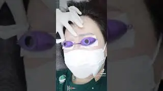 Laser Sulam Alis Gagal (Perbaikan Sulam Alis)