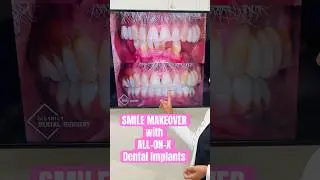 Smile Makeover with All-on-X Dental Implants | Dr. Raha Yousefi at District Dental Surgery