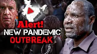 Alert! Mpox Virus in India Outbreak| NEW PANDEMIC.