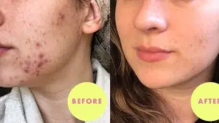 The face shop white seed brightening discovery kit review / serum for acne prone skin