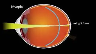 Low-dose atropine eyedrops no better than placebo for slowing myopia progression