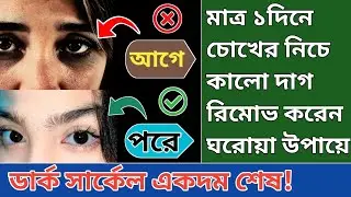 চোখের নিচে কালো দাগ কেন হয় || চোখের নিচে কালো দাগ পরলে কি করবো || Dark circle remove ||