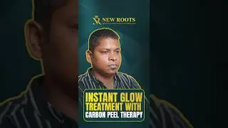 Skin Rejuvenation with Carbon Peel Treatment #skinrejuvenation #carbonpeel #shorts