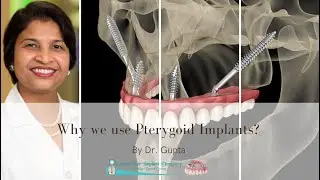 Specialized Technique by Dr. Gupta: Why we use Pterygoid Implant?