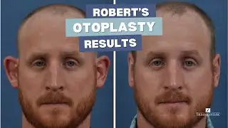 Robert's SHOCKING Otoplasty Results!