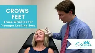 Crows Feet | Treatment for More Youthful Looking Eyes