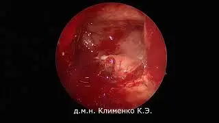 Одонтогенный гемисинусит. Эндоскопическая полисинусотомия.