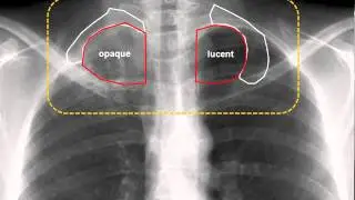 Pancoast Tumor & Horner Syndrome