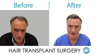 FUT/FUE combo harvesting from SDA for 4741 follicle units transplanted  & SMP